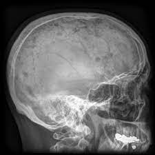 Related online courses on physioplus. Multiple Myeloma Radiology Reference Article Radiopaedia Org