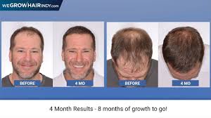 Most girls dream of a smart shock on their head, but few of them know how many cm grow. 4 Months Post Hair Transplant We Grow Hair Indy