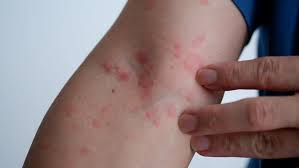 Image result for Skin Infection