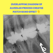 Dentowoman Radiographs Interpretation Series