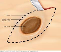Examples of excisional biopsy procedures include elliptical excision, deep scoop shave, and punch biopsy for small lesions. Skin Biopsy Mayo Clinic
