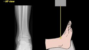 Image result for Ankle XRay