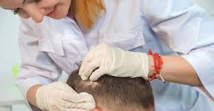100% hair transplant results you can examine by 9 to 12 months after the fue hair transplant. Won T The Transplanted Hair Grow Experts Burst Myths About The Procedure Lifestyle Beauty English Manorama