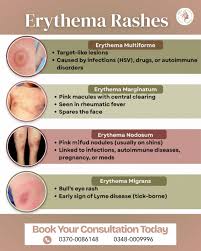 Image result for Erythema Multiforme Causes