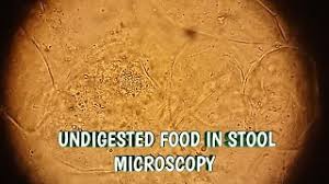 Be aware that all diseases causing malabsorption can cause. Undigested Food In Stool Microscopy Udf In Stool Microscopy At 40x Youtube