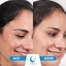 ✅ TOXINA BOTULÍNICA (ANTES Y DESPUÉS) 🙋‍♀️