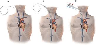 current avalon cannulation technique guidewire is placed to