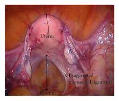 Demonstration of pelvic anatomy by modified midline transection that maintains intact internal pelvic organs. Figure 4 A Novel Technique Of Uterine Manipulation In Laparoscopic Pelvic Oncosurgical Procedures The Uterine Hitch Technique