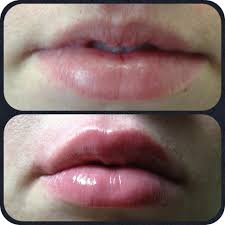 This Client Had A Signficantly Smaller Upper Lip And Our Registered Nurse Fixed Her Right Up With The Help Of Juvaderm To Give Her Lips A Plump Full But Natura