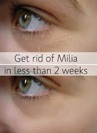 Whiteheads and zits from clogged pores. Diygoodtips Com Nbspthis Website Is For Sale Nbspdiygoodtips Resources And Information Bumps Under Eyes Skin Remedies Beauty Hacks
