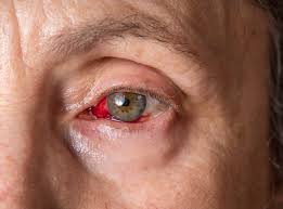 Image result for Conjunctivitis