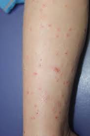 Image result for Papular urticaria