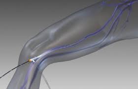 Safenoablación láser