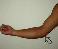 Recipients face a year of strenuous rehabilitation before they can return to action. Ulnar Collateral Ligament Injury Of The Elbow Wikipedia