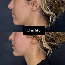 The Mercedes of Botox