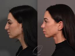Rhinoplasty Before & After Photos Patient 1001525 | Serving Rochester,  Syracuse & Buffalo, NY | Quatela Center for Plastic Surgery