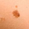 It begins in the melanocytes, which are skin cells that produce a pigment called melanin. 1
