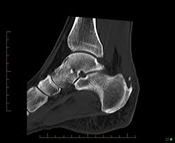 They are considered voluntary muscles. Foot Ankle Injuries Sports Imaging Melbourne Radiology