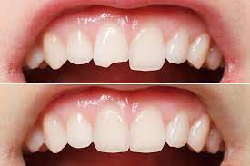 Does blue cross blue shield cover dental bonding. Teeth Bonding Burlington Nc Affordable Tooth Bonding
