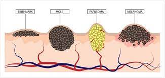 Cancer cells can spread to other parts of the body and grow when cancer cells do this, it's called metastasis. How Is Melanoma Diagnosed And Treated