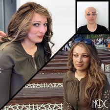 Yasanilan Alopesi Rahatsizliklari Nedeniyle Dokulen Saclariniza Cozum Hdc De Hayatini Sinirlama Ozgurce Yasa The Solution For Hair Loss Due To Alopecia