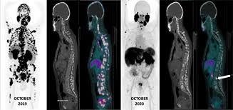 The american cancer society provides detailed information on prostate cancer and its treatment. Pet Ct With 18f Psma In Patients With Prostate Cancer Review Of The Initial Experience