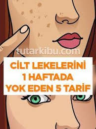 Yuzdeki Lekeleri 1 Haftada Yok Eden Tarifler Skin Problems Skin Spots Natural Beauty Tips