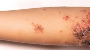 I bambini e gli adulti possono contrarre la dermatite stafilococcica come segue: Impetigine Che Cos E Cause E Come Si Cura Saperesalute It