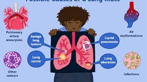 Lung cancer sometimes creates a substance similar to hormones, causing a wide variety of symptoms called paraneoplastic syndrome. Possible Causes Of A Lung Mass