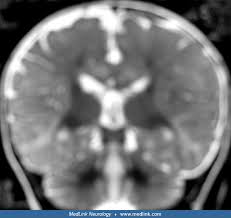 Shaken Baby Syndrome Medlink Neurology