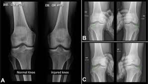 Lateral Collateral Ligament Injury Of The Knee Physiopedia