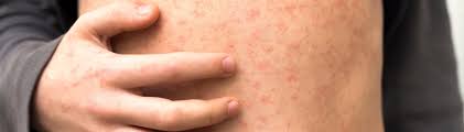 Image result for Measles