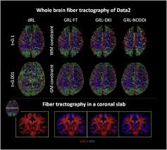 Marcus glenn richardson was born on march 9, 1983, in the united states of america. Generalized Richardson Lucy Grl For Analyzing Multi Shell Diffusion Mri Data Sciencedirect