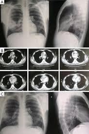 Image result for Lung Abscess