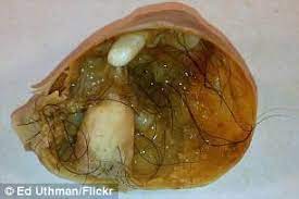 We did not find results for: Calle Hack Finds Cyst With Hair And Teeth Was Caused Her Period Pain Daily Mail Online