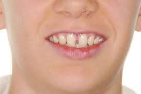 Modernste ausstattung mit wohlfühlambiente machen uns einfach.anders. Korperliche Zahnbewegungen Und Transversale Korrekturen Teil 2 Zwp Online Das Nachrichtenportal Fur Die Dentalbranche