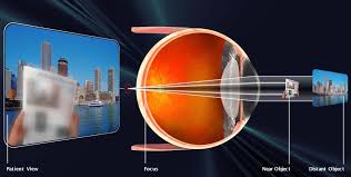 Image result for Presbyopia