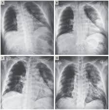 Some infections, however, cause acute pulmonary histoplasmosis as. X Ray Helps Diagnose Coronavirus In Vietnamese Man