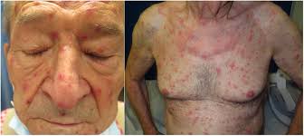 JEADV Clinical Practice: Vol 4, No 1