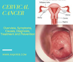 Most cases of cervical cancer are caused by infection with human papillomavirus (hpv), which is preventable with a vaccine. Cervical Cancer Overview Symptoms Causes Diagnosis Treatment And Prevention Anjkreb
