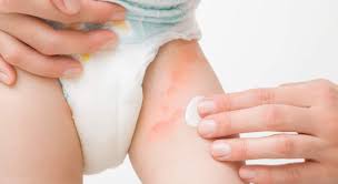 Image result for vyrážka u dětí