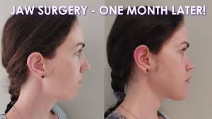 DOUBLE JAW SURGERY: ONE MONTH LATER (This is harder than I thought...)