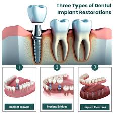 Image result for dental implant