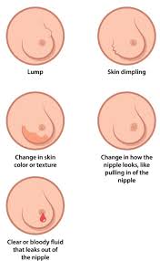 Image result for Breast Cancer Staging