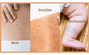You can find it online at www.cancer.org. Can You Get A Tattoo Over Moles Freckles And Birthmarks Tattoo Moisturiser