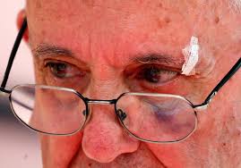 Pope Francis Suffers Black Eye With ...