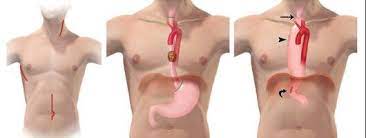 The incisions are made in the neck, chest and abdomen (belly) to remove the esophagus and rebuild the gastrointestinal tract. Mckeown Esophagectomy Skin Incision Red Line For Right Thoracotomy Download Scientific Diagram