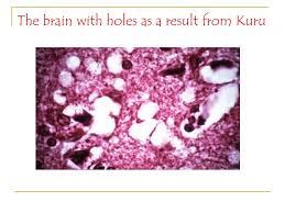 Dolar, euro gibi major kurlar anlık olarak güncellenmektedir. Kuru A Prion Disease Ppt Video Online Download