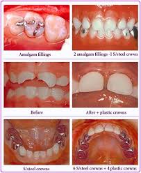 Root Canal In Milk Teeth Dr Ashish Shah