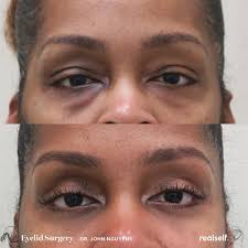 6 Things You Need To Know About Eyelid Surgery Droopy Eyelids Eye Bag Surgery Eye Lift Surgery